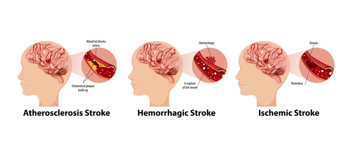 Three types of stroke
