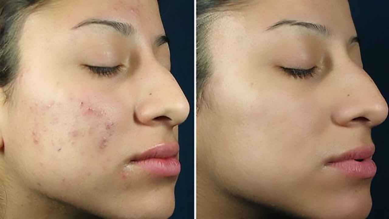 Before and after cleansing the skin with a chemical peel