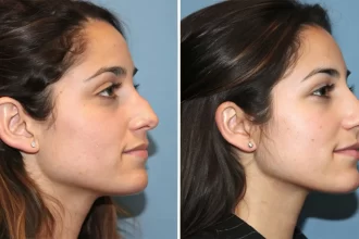 Before and after rhinoplasty